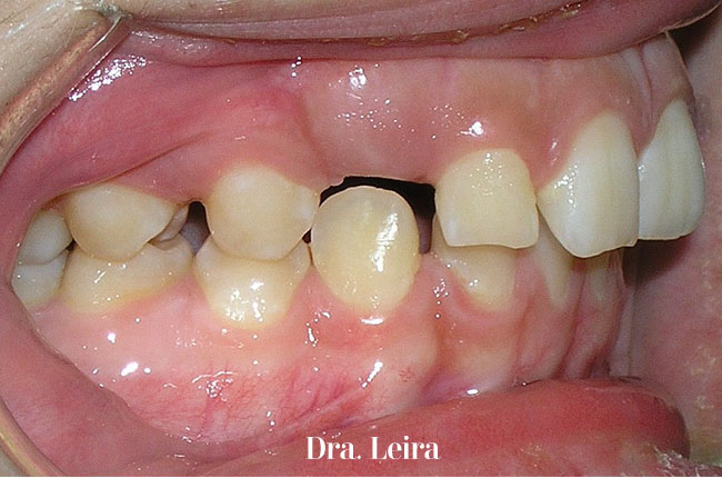 La paciente de la Clínica Dra. Leira tenía un problema de maloclusión de cl II