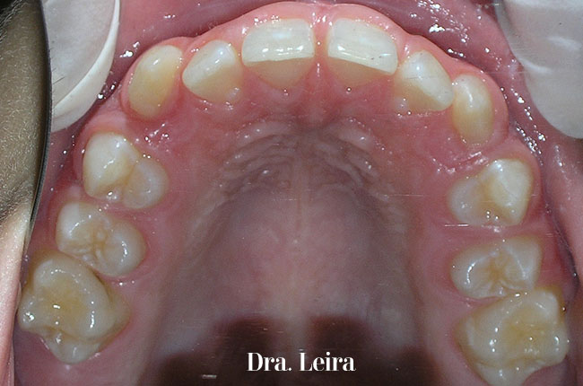 Imagen previa al tratamiento con brackets Damon para corregir sobremordida y diastemes