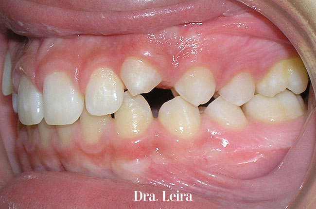 En la Clínica Dental Dra. Leira somos expertos en el tratamiento para corregir la diastemes