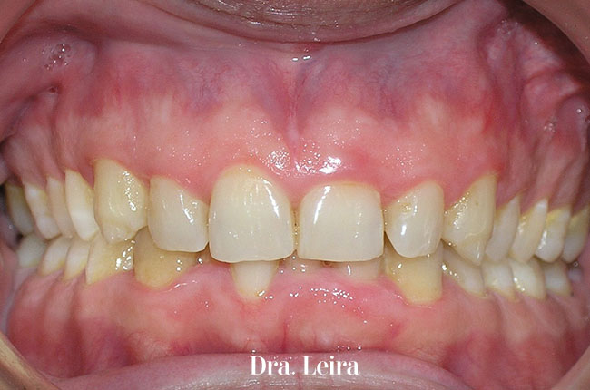Imagen del paciente con sonrisa gengival y apiñamiento antes de recibir el tratamiento