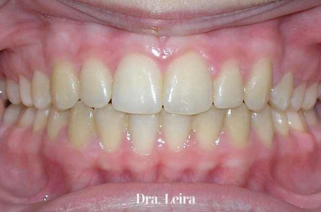 Imagen de la paciente con mandíbula retruida, sobremordida y apiñamiento severo después del tratamiento con brackets Damon